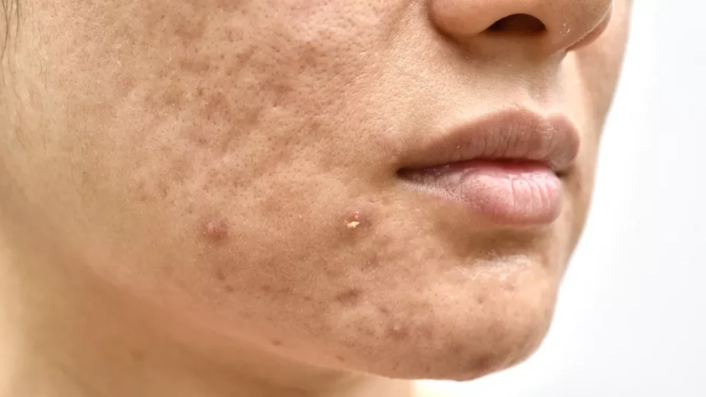 berapa kali treatment untuk menghilangkan bopeng