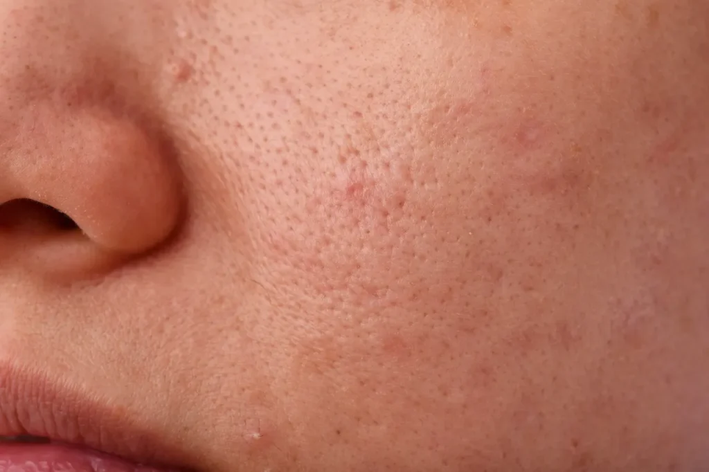 facial untuk mengecilkan pori pori