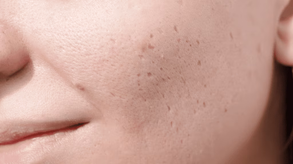 microneedling untuk bopeng