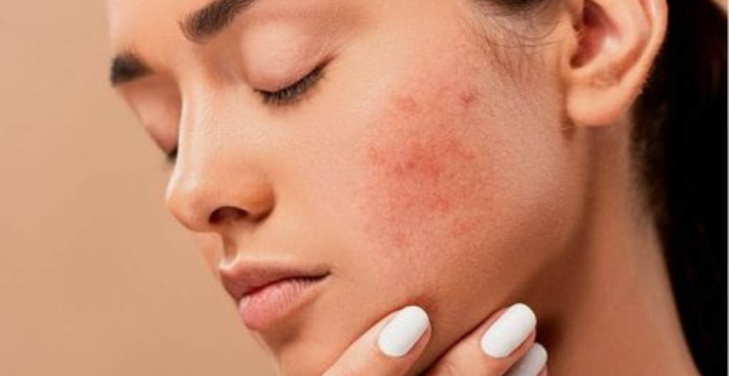obat fungal acne di apotek