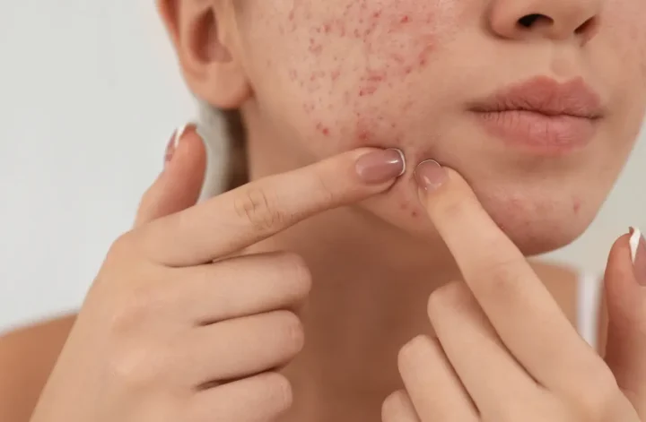 retinol untuk jerawat mendem