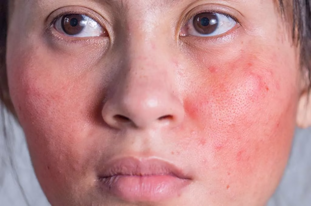 ciri-ciri muka iritasi karena skincare