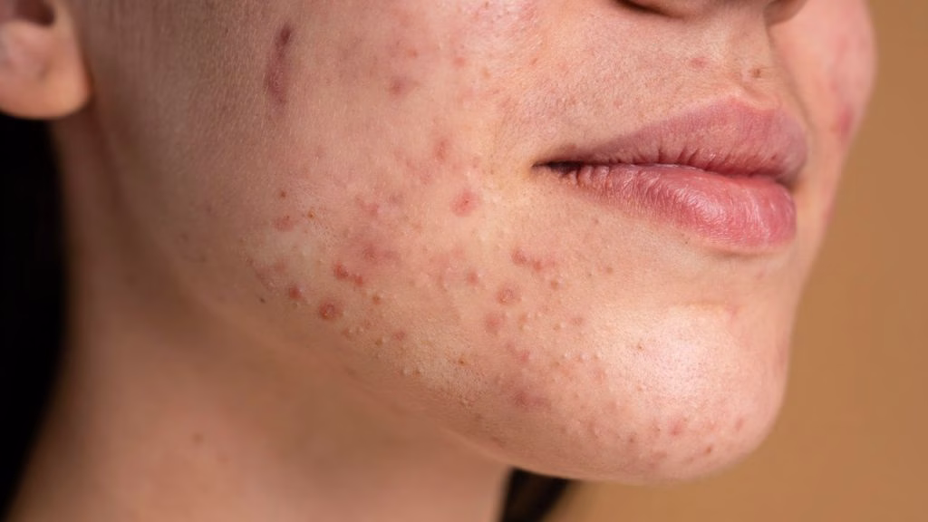 jerawat di rahang