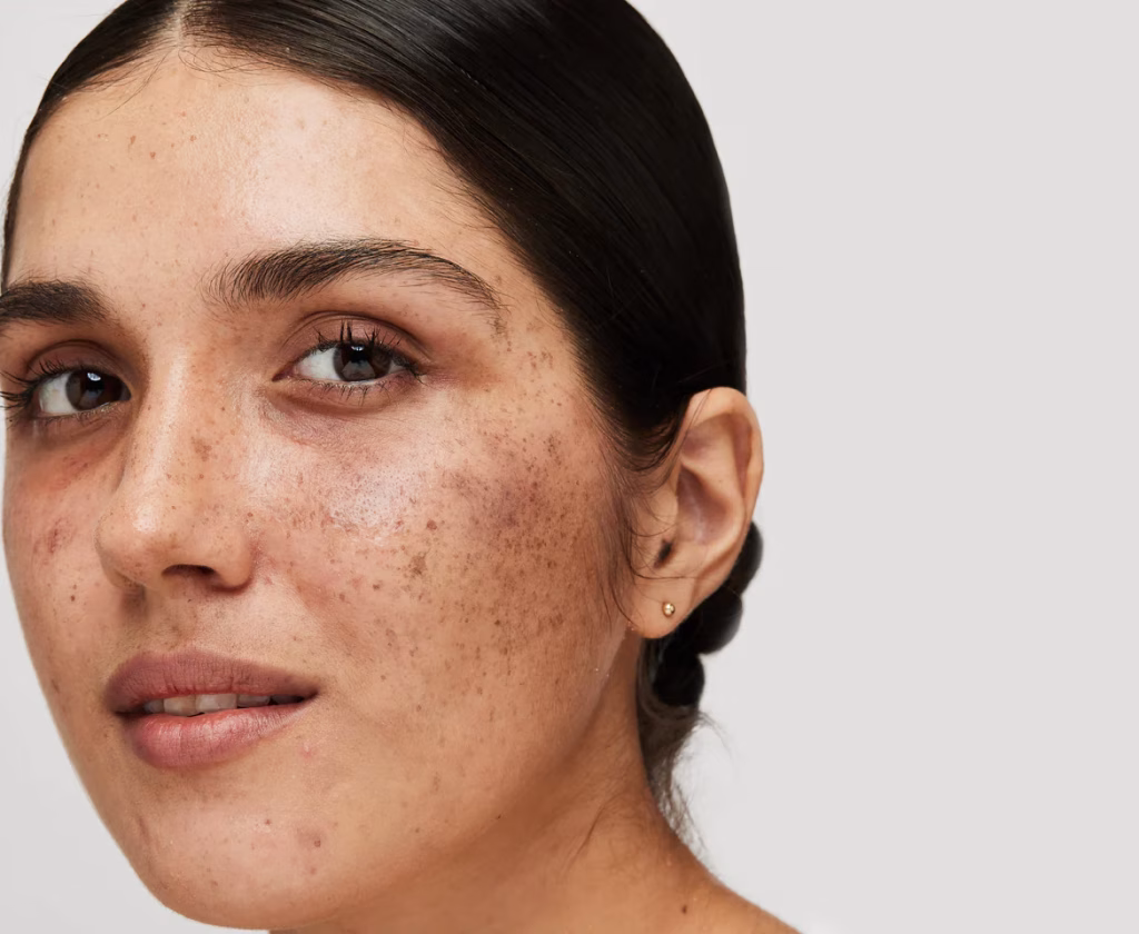 melasma
