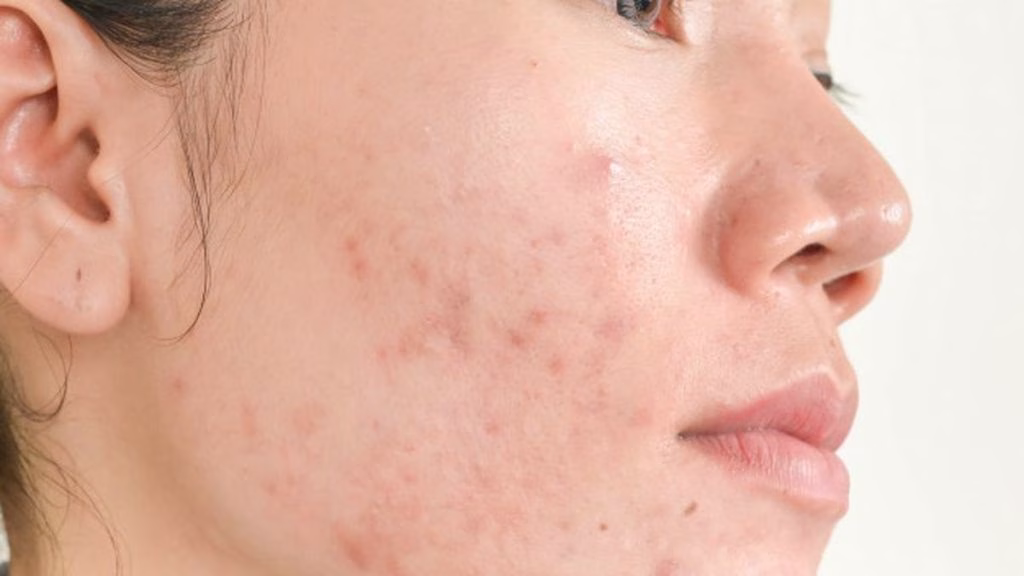 ciri jerawat begadang