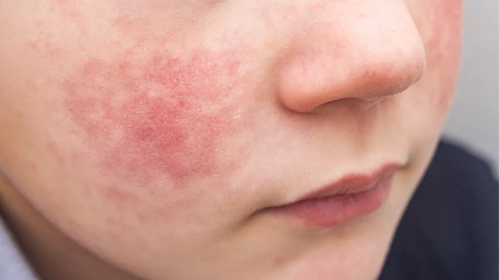 menghilangkan kemerahan wajah dengan cepat