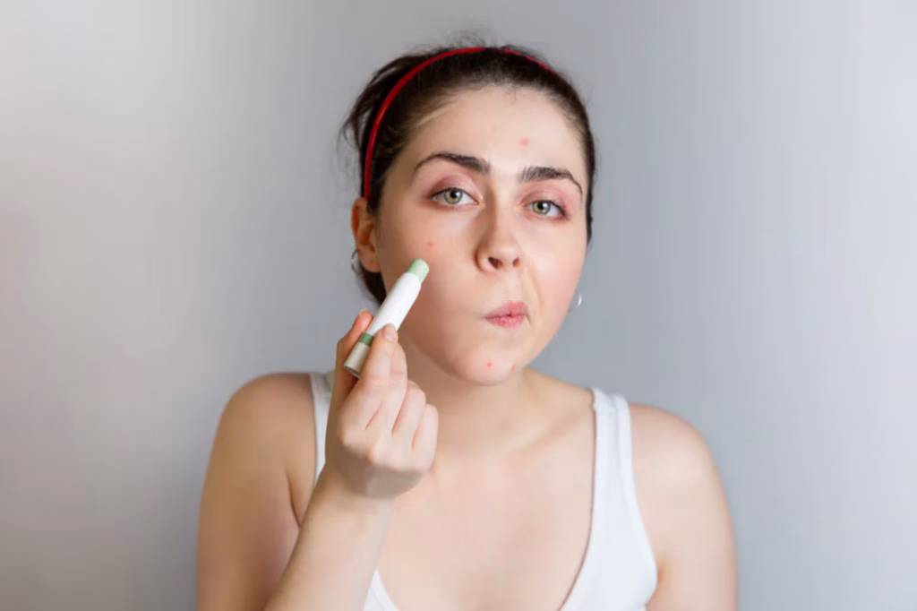 cara menutupi jerawat