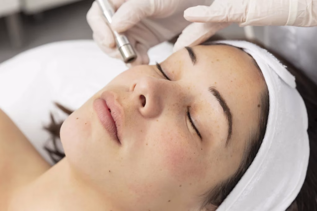 microneedling untuk bopeng
