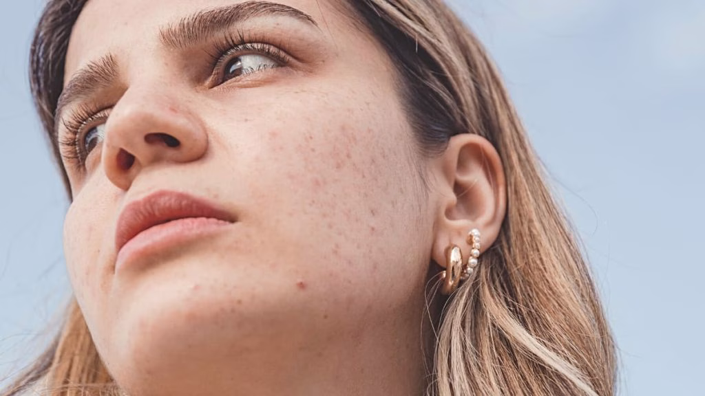 Ciri-Ciri Muka Iritasi karena Skincare yang Harus Kamu Waspadai