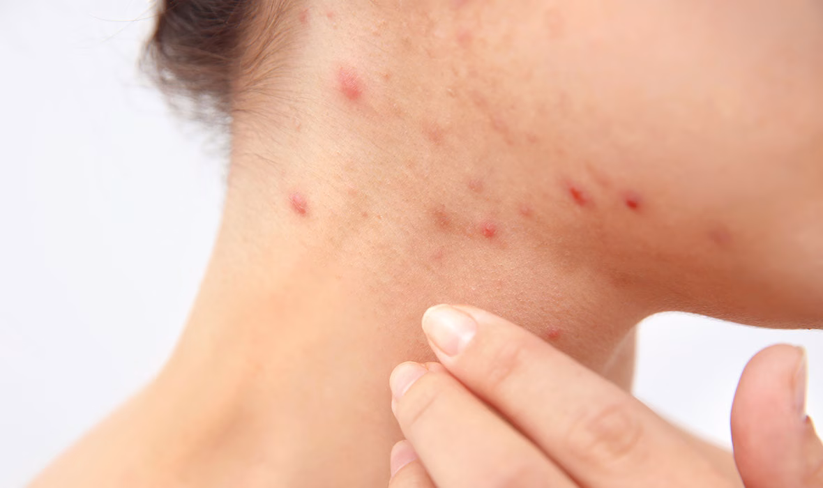 Jerawat di Dagu: Penyebab Tersembunyi dan Langkah Sederhana untuk Mengatasinya