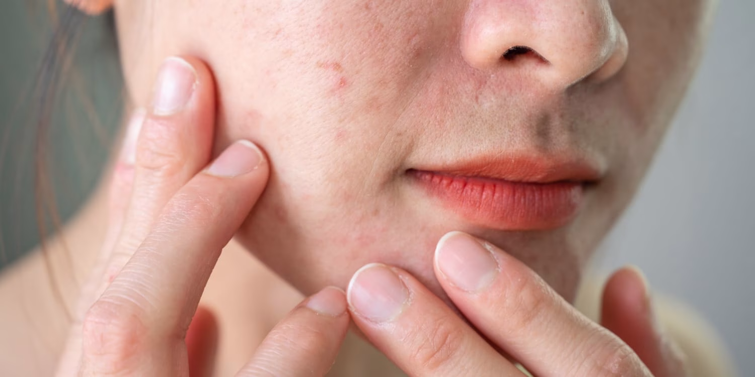Moisturizer untuk Acne Prone Skin yang Tepat Bisa Ubah Rutin Perawatan Kulitmu