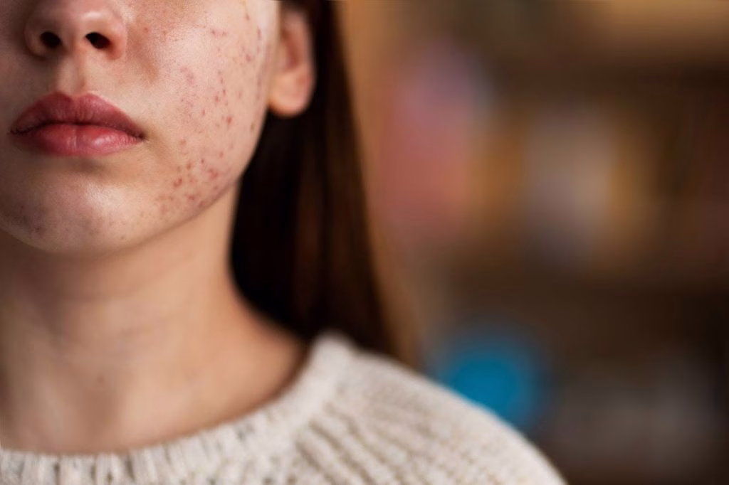 Moisturizer untuk Acne Prone Skin yang Tepat Bisa Ubah Rutin Perawatan Kulitmu