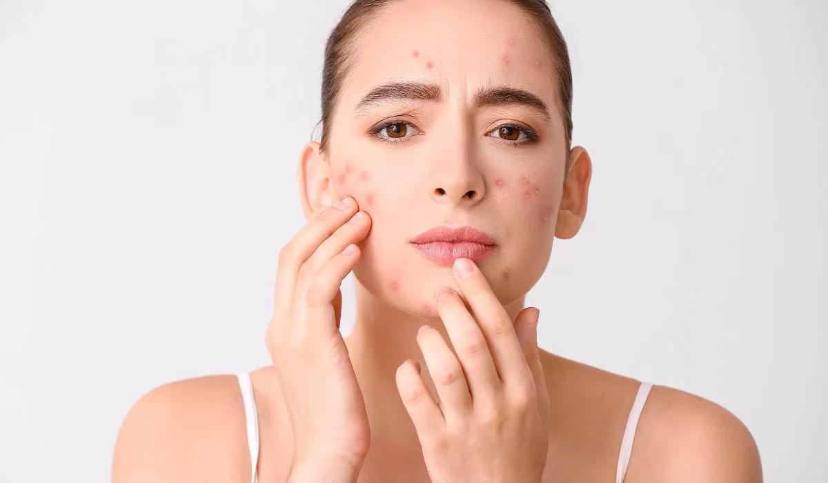 Tidak Cocok Skincare dan Cara Menyikapinya dengan Bijak