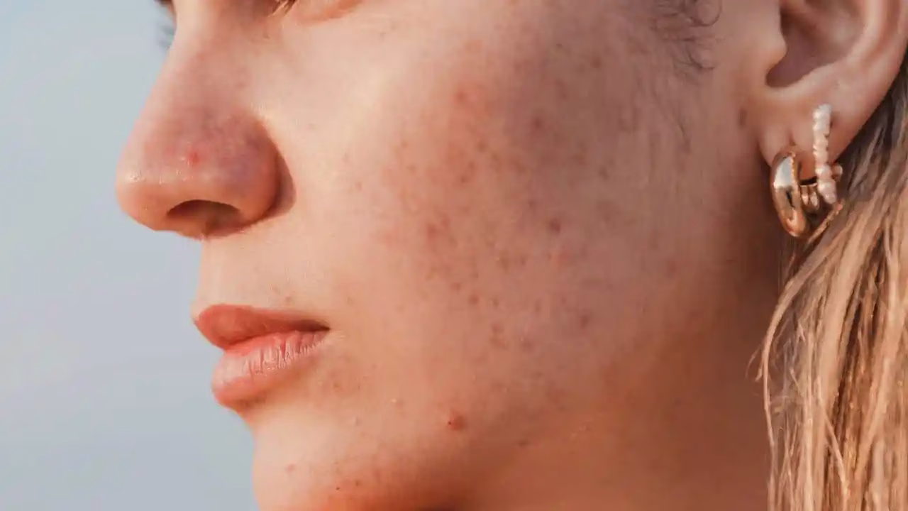 Apakah Sunscreen Bisa Menghilangkan Bekas Jerawat?