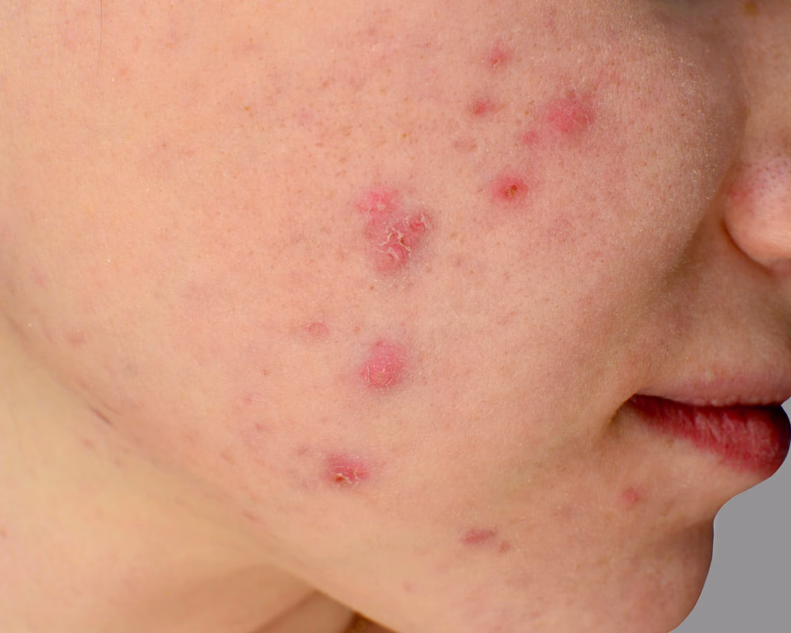 Mengatasi Iritasi Skincare dengan Bijak untuk Kulit yang Lebih Nyaman