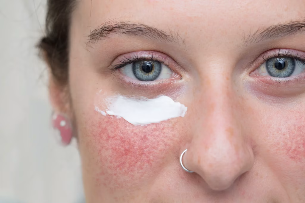 Mengatasi Iritasi Skincare dengan Bijak untuk Kulit yang Lebih Nyaman