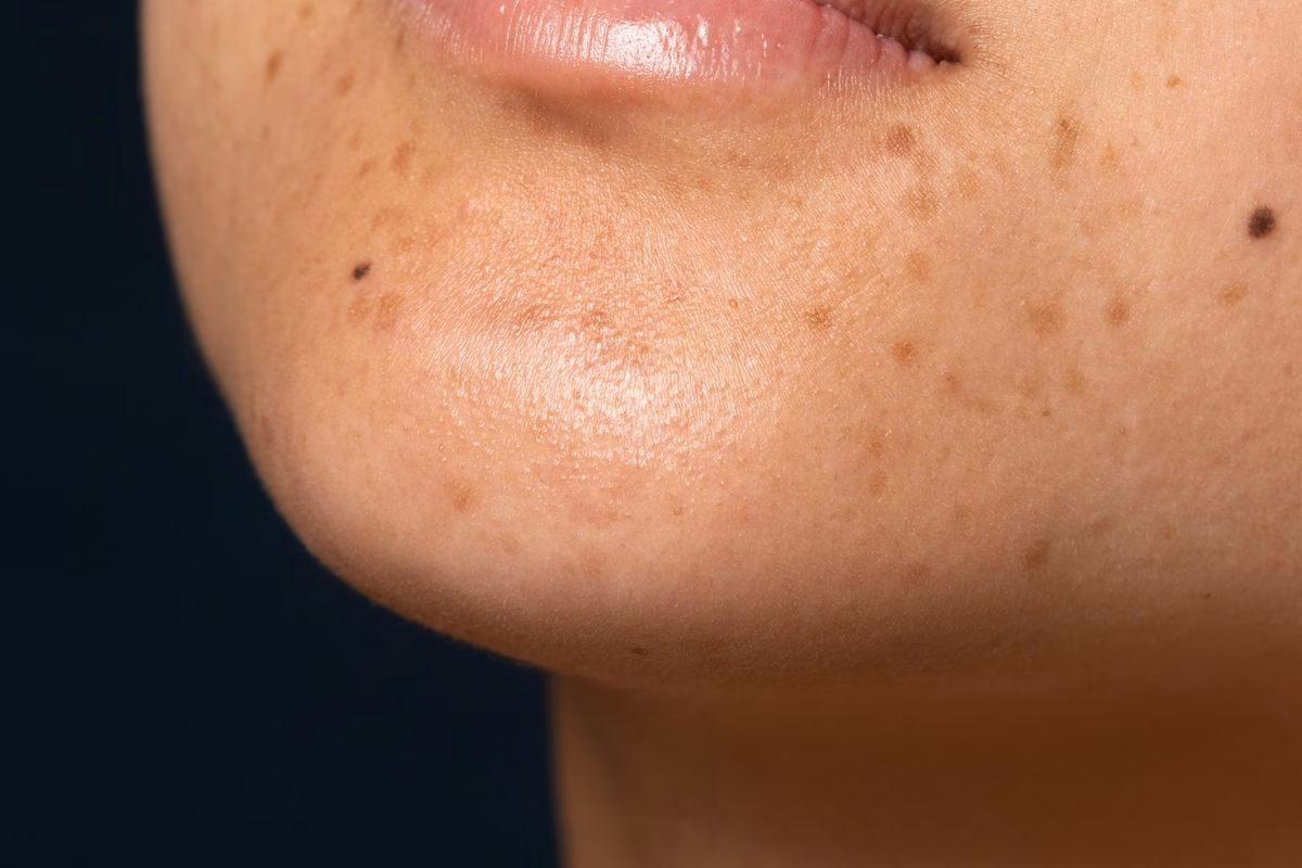 Dark Spot Adalah Kondisi Kulit yang Sering Mengganggu Kepercayaan Diri