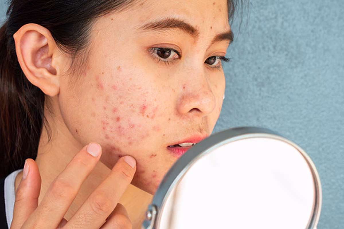 Skin Barrier Rusak: Penyebab, Tanda, dan Cara Memulihkannya dengan Lembut