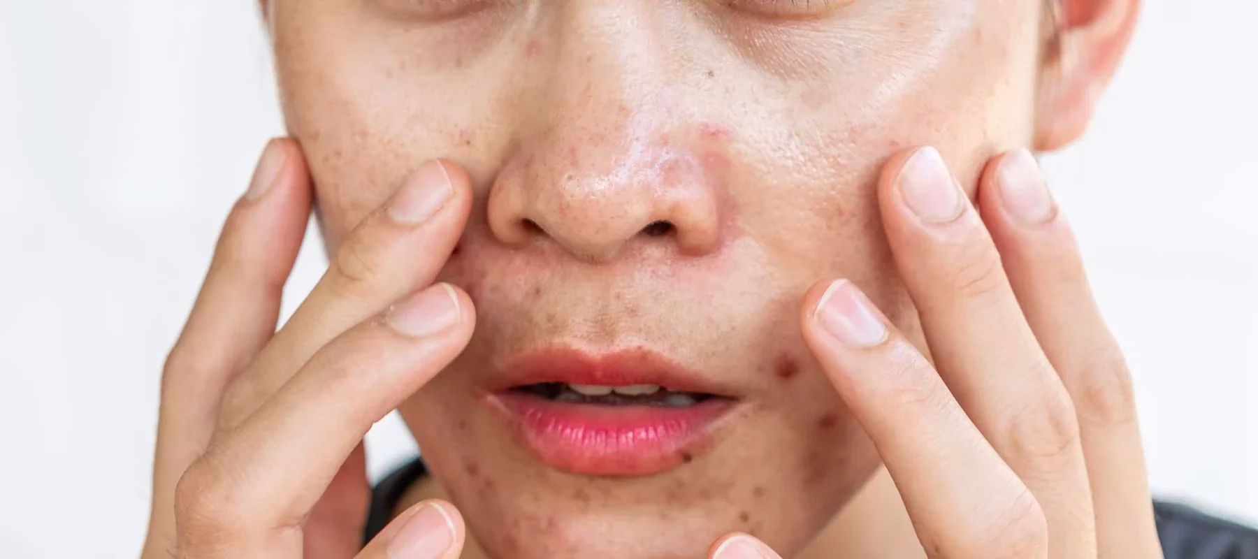 Skincare untuk Kulit Berminyak yang Bikin Wajah Fresh Tanpa Kilau Berlebih