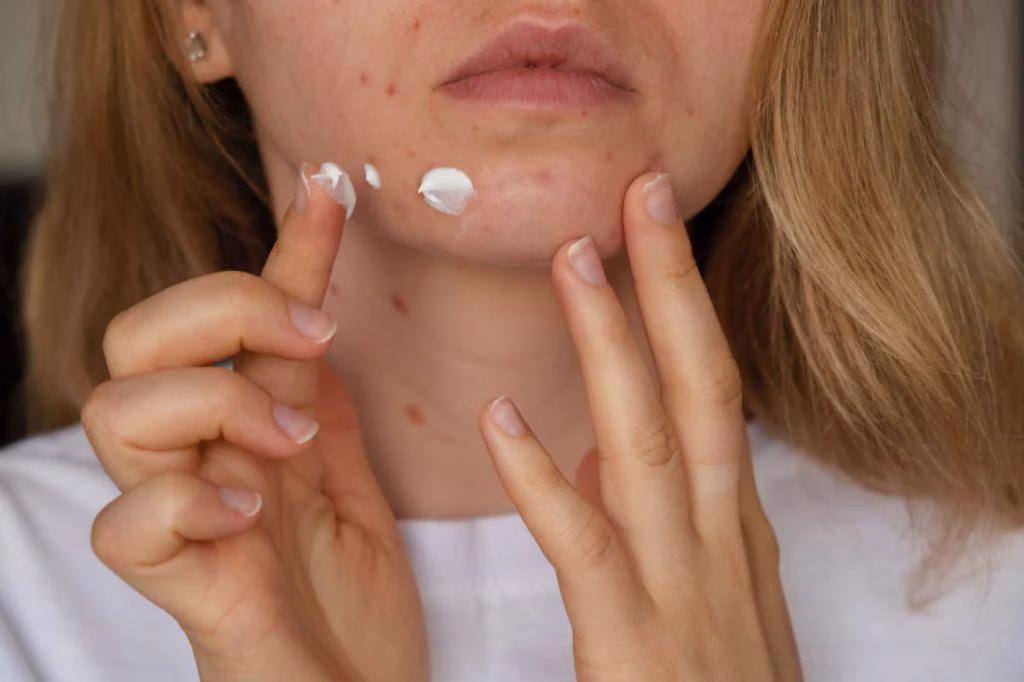 Memahami Acne Prone Skin dan Cara Menjaganya dengan Lembut
