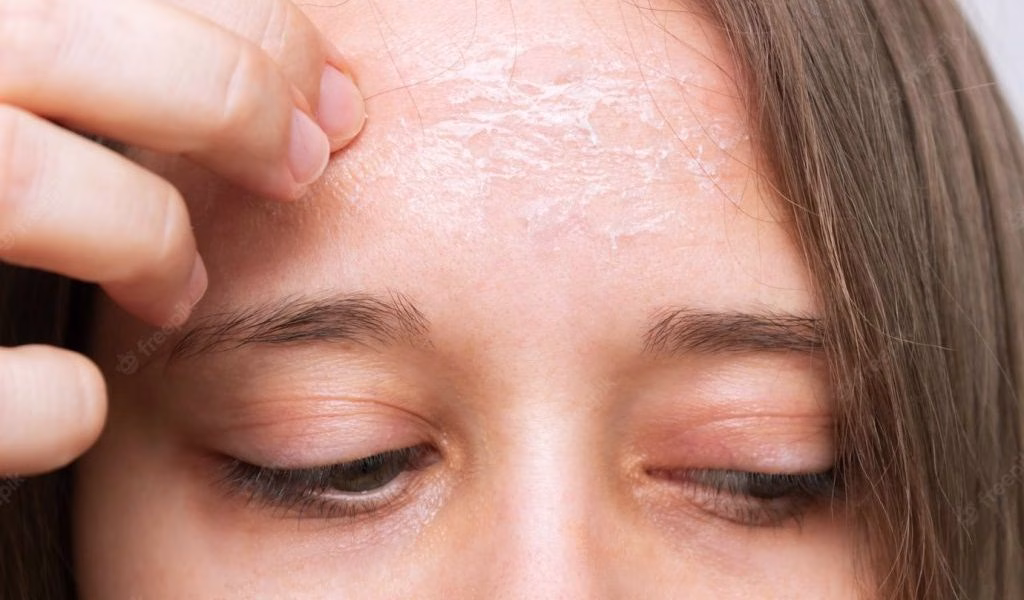 Ciri Kulit Wajah Tipis: Kenali Tandanya Sebelum Salah Pilih Skincare