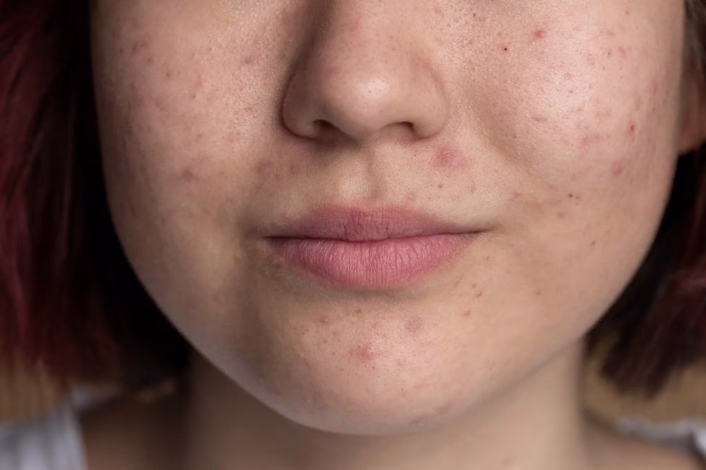 Comedogenic dan Rahasia Kulit Sehat yang Sering Terlewat