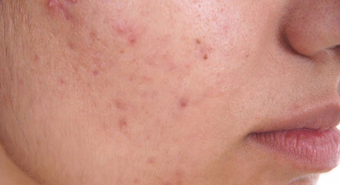 Non Acnegenic Adalah: Memahami Produk yang Ramah bagi Kulit Berjerawat