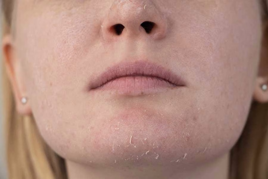 Rahasia Merawat Kulit Normal to Dry Skin agar Tetap Lembab Sepanjang Hari