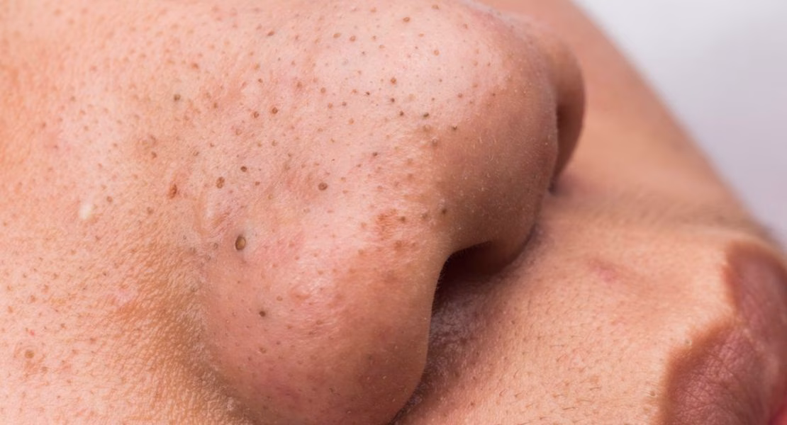 Salicylic Acid untuk Komedo: Cara Lembut Membersihkan Pori dan Mengembalikan Kepercayaan Diri