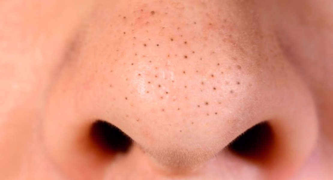 Blackhead Adalah Komedo Hitam yang Sering Mengganggu Penampilan Kulit