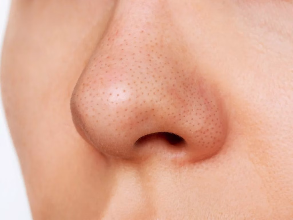 Blackhead Adalah Komedo Hitam yang Sering Mengganggu Penampilan Kulit