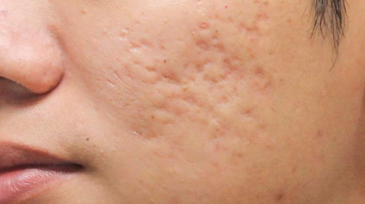 Perbedaan Scar dan Bopeng yang Harus Kamu Pahami