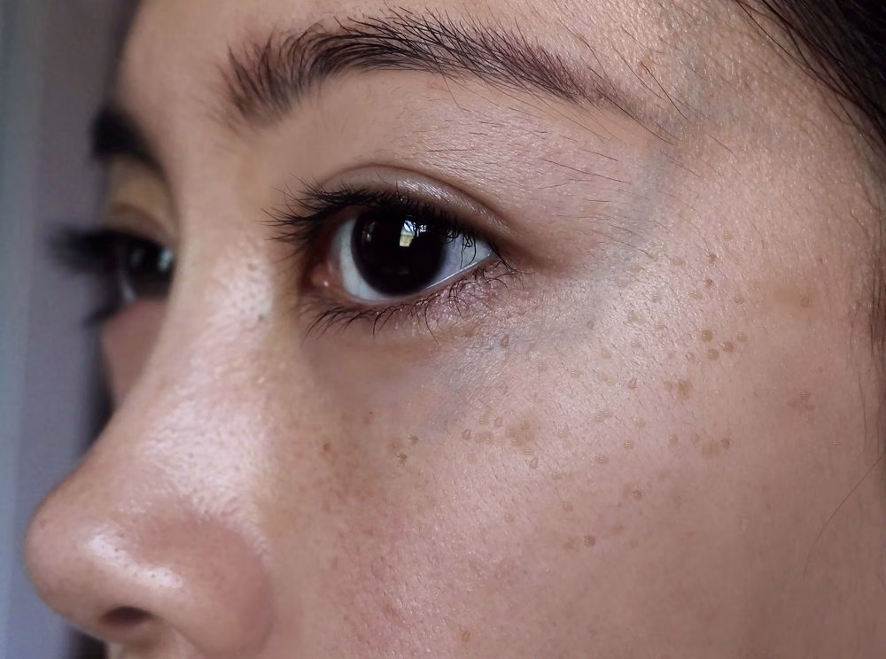 Dark Spot pada Kulit: Penyebab yang Sering Terabaikan dan Langkah Praktis untuk Mengatasinya