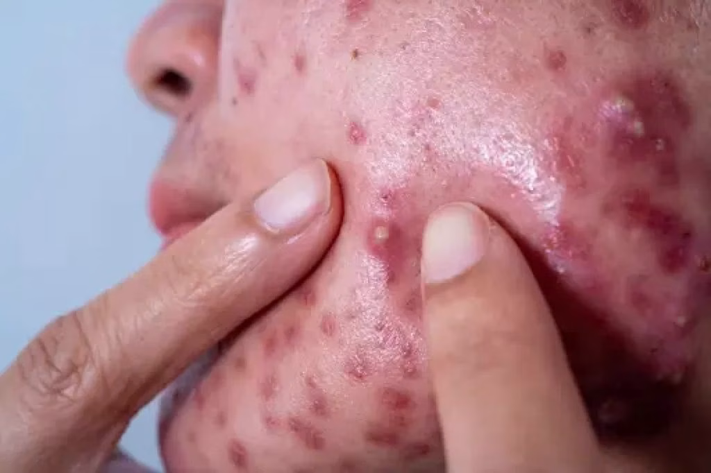 Jerawat Aktif yang Muncul Tiba-tiba? Ini yang Perlu Kamu Ketahui dan Lakukan