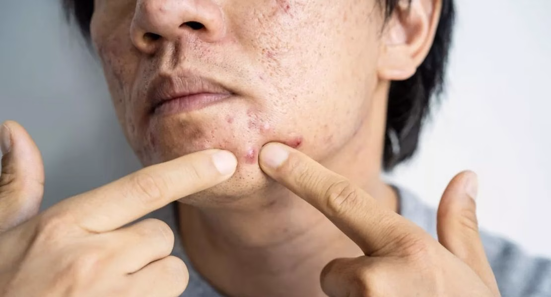Jerawat Matang: Cara Memahami dan Merawatnya dengan Bijak