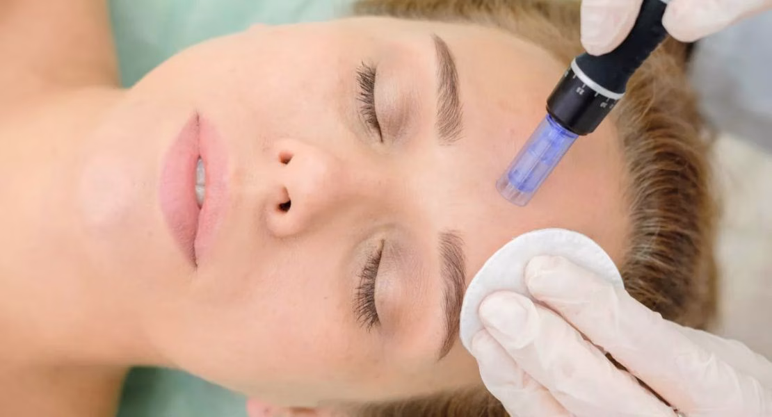 Microneedling Adalah Rahasia Kulit Sehat yang Banyak Dicari Orang