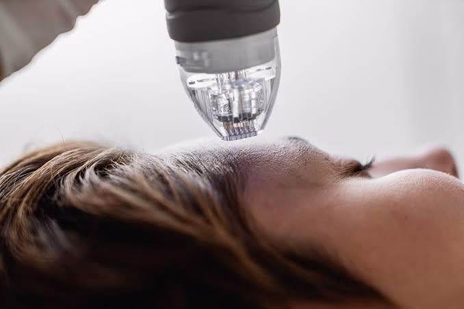 Microneedling Adalah Rahasia Kulit Sehat yang Banyak Dicari Orang