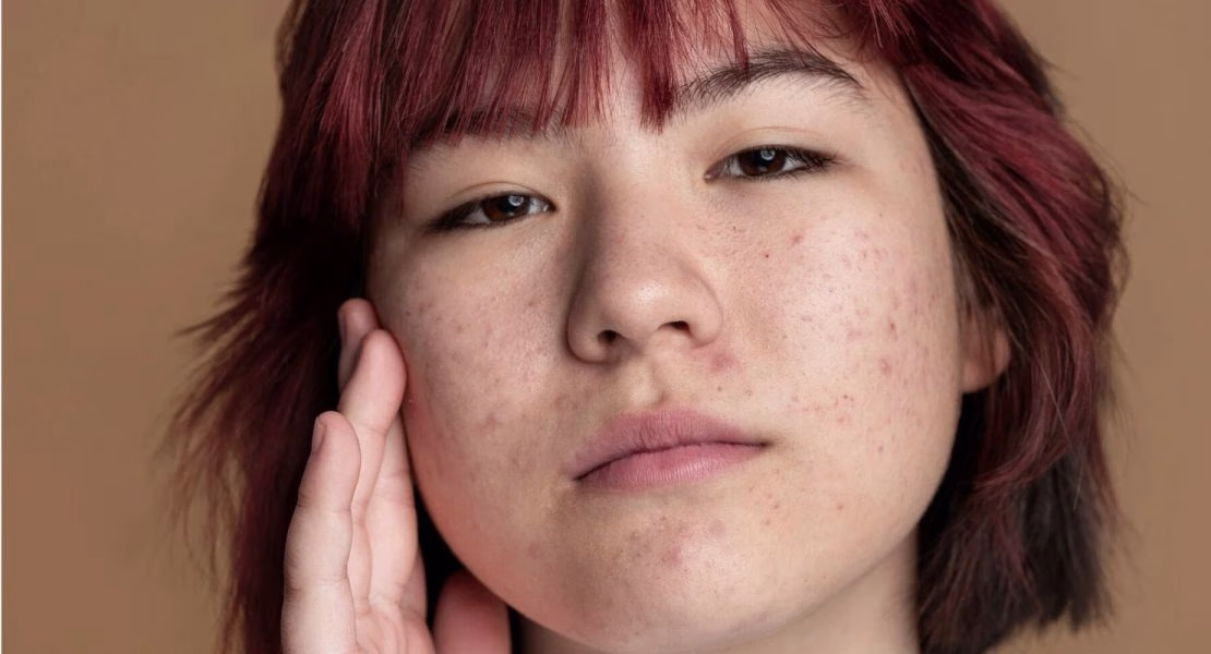 Perbedaan Melasma dan Flek Hitam yang Penting Diketahui untuk Kulit Sehat