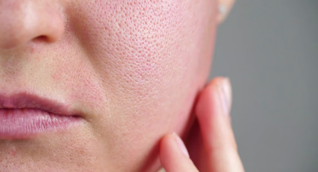 Pore Tightening Artinya dan Cara Mengencangkan Pori Kulit agar Wajah Tampak Lebih Halus