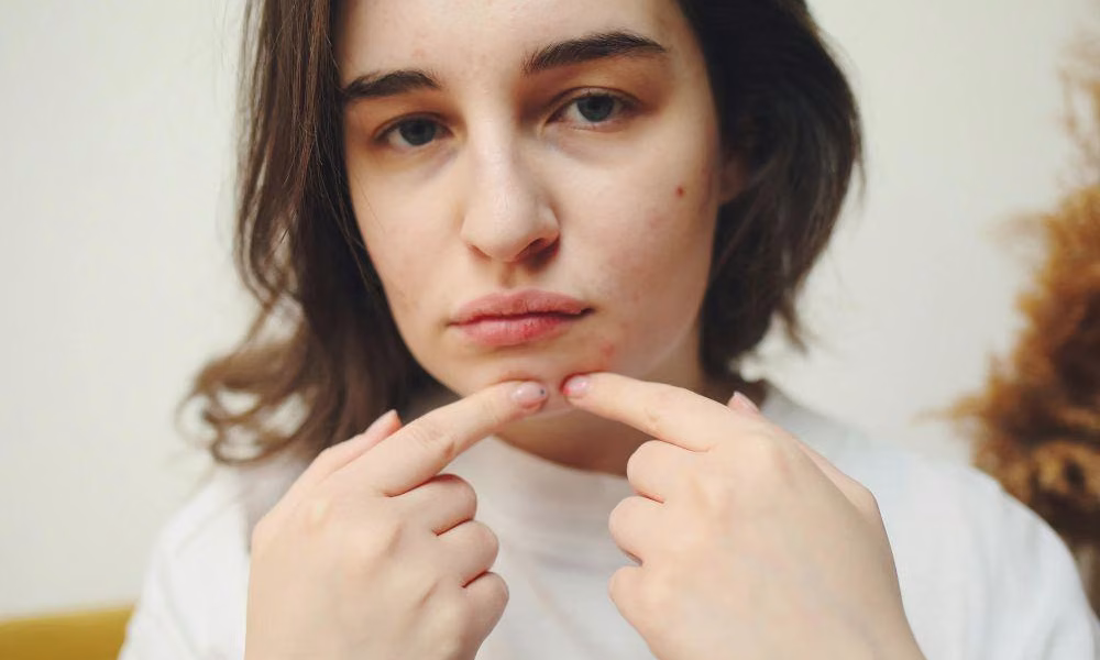 Retinol untuk Bopeng: Cara Mengatasi Bekas Jerawat yang Mengganggu Kepercayaan Diri