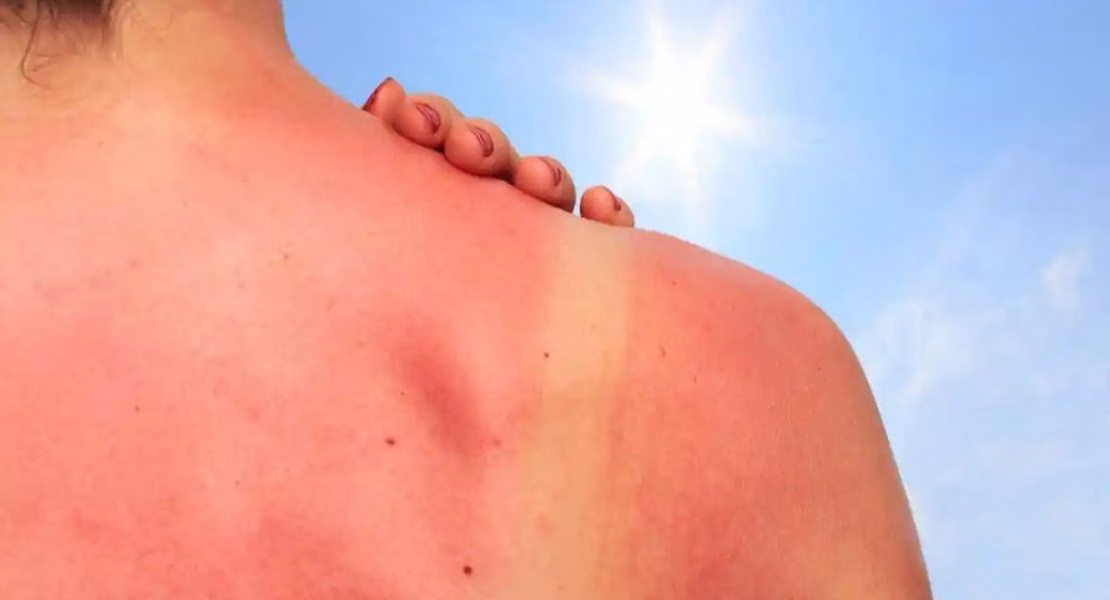 Skincare untuk Kulit Sunburn yang Membuat Kulit Lebih Nyaman Setelah Terpapar Matahari