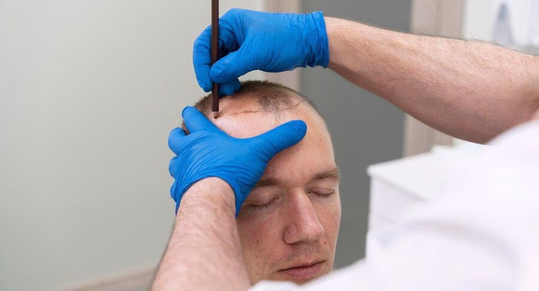 Transplantasi Rambut Adalah Pilihan Utama Mengatasi Kerontokan Rambut yang Menetap