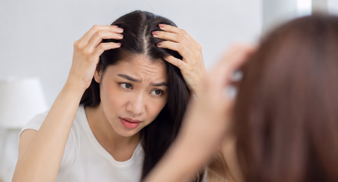 Jerawat di Kulit Kepala Bisa Dihadapi dengan Perawatan yang Tepat