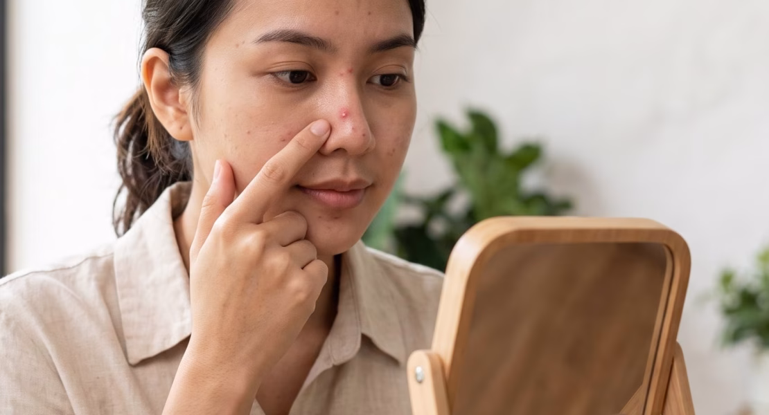 Penyebab Jerawat di Hidung yang Sering Muncul di Area T-Zone
