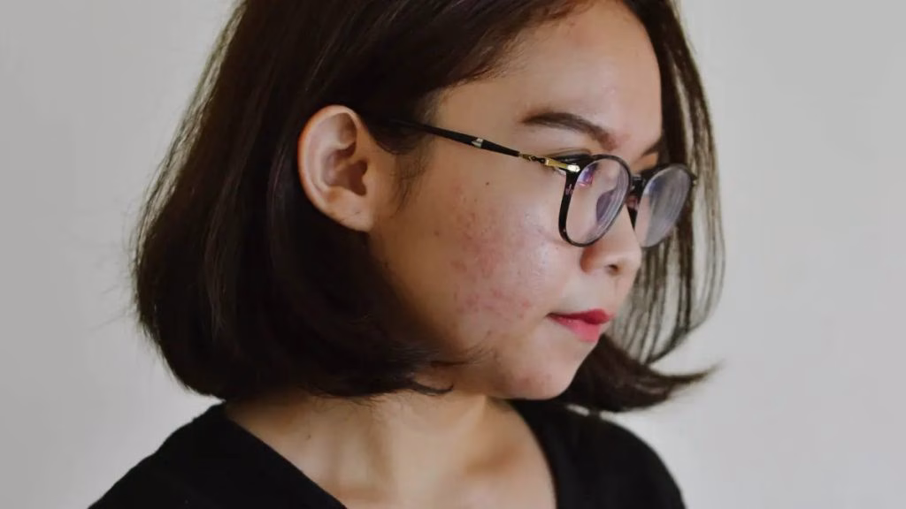 Acne Fighter untuk Merawat Kulit yang Mudah Berjerawat