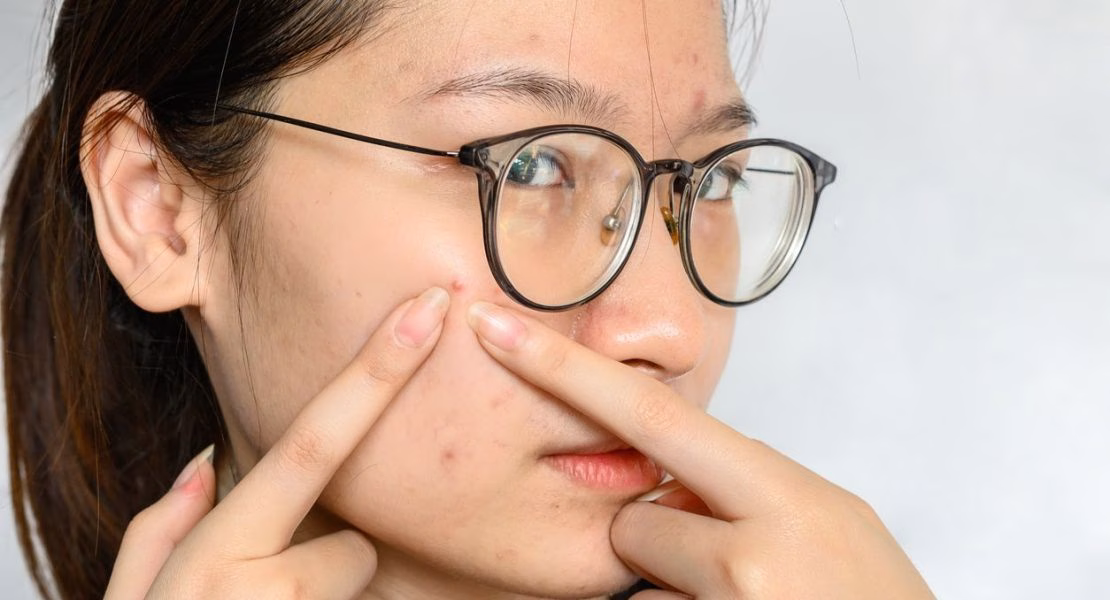 Acne Fighter untuk Merawat Kulit yang Mudah Berjerawat