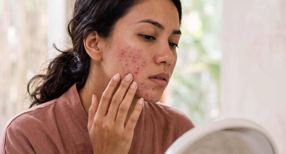 Ciri Tidak Cocok Skincare yang Perlu Kamu Kenali Sejak Dini