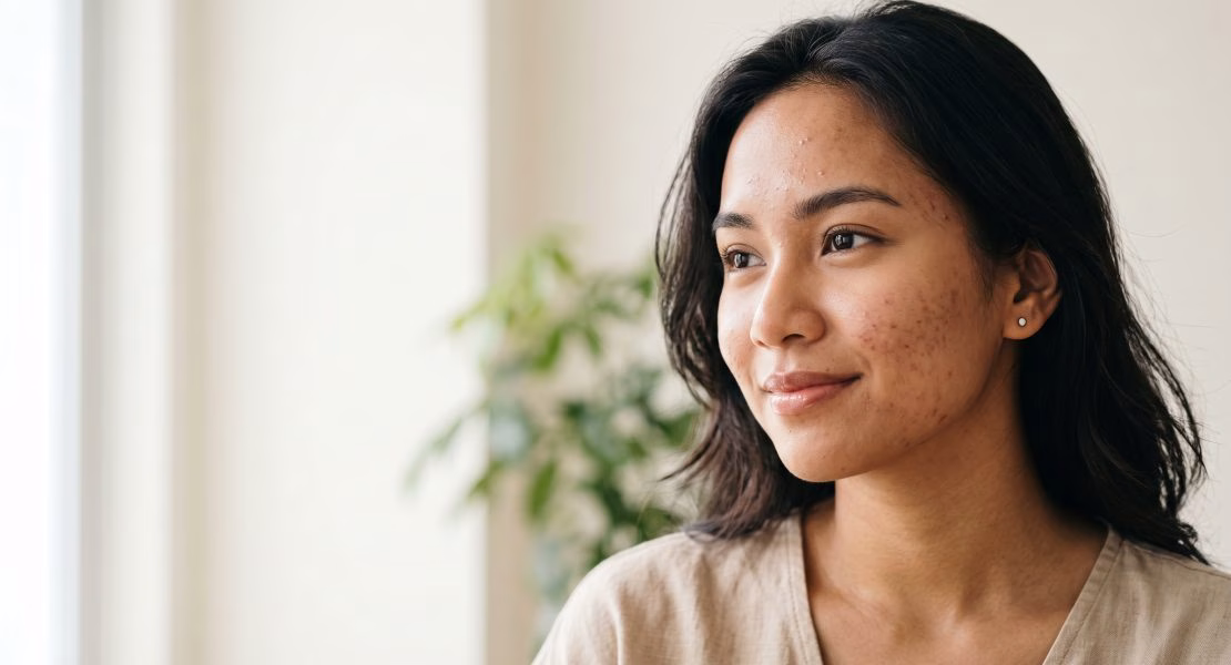 Skincare untuk Fungal Acne yang Aman bagi Kulit Bermasalah