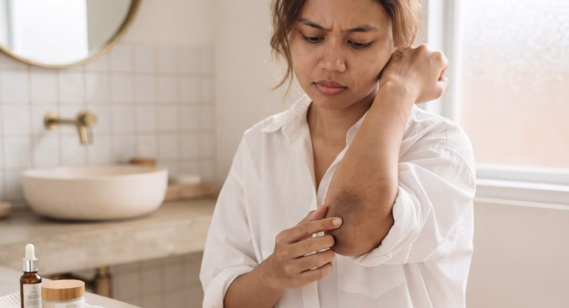 Siku Gelap Bikin Kurang Pede? Ini Cara Merawatnya agar Lebih Cerah